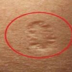 Ce reprezintă, de fapt, cicatricea de pe partea superioară a brațului