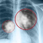 Credea că a răcit, dar medicii i-au dat o veste devastatoare. Ce ascundea, de fapt, o tuse banală