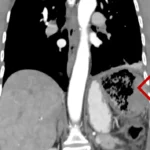 De necrezut! Ce obiect au găsit chirurgii în corpul unei femei. Fusese uitat acolo în anul 1999