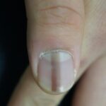 O tânără a văzut că are o linie dreaptă și maro pe unghie. Când a mers la spital, medicul i-a dat vestea ce i-a schimbat viața