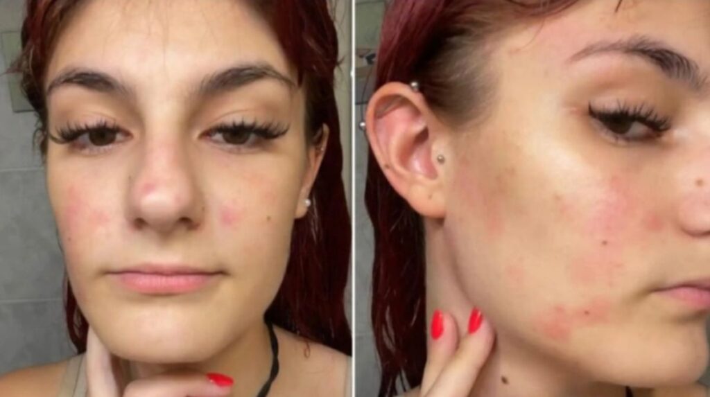 Coșmarul prin care trece Diana, o româncă din Spania alergică la apă: "Mulți oameni au crezut că sunt nebună”